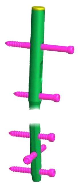 Wkręt zaślepiający End cap Wkręt blokujący Ø5,0mm dla gwoździ Ø7,0mm Ø12,0mm Locking screw Ø5,0mm for nails Ø7,0mm Ø12,0mm Wkręt blokujący Ø5,0 mm dla gwoździ Ø10,0mm Ø12,0mm Locking screw Ø5,0mm for