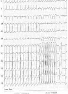 602 Ewa Mroczek et al. Rycina 3. Spontaniczna indukcja częstoskurczu z wąskimi QRS przerwanego terapią ATP w trakcie przygotowania do badania elektrofizjologicznego zabiegu na 170/min.