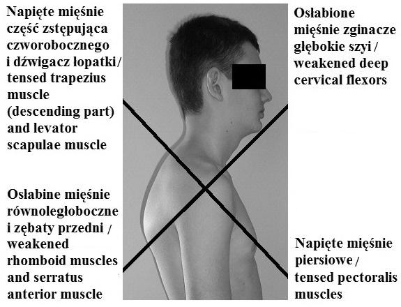 Postępy Rehabilitacji (2), 53 67, 2017 55 która wpływa na nierównomierne obciążenia stawów, powodując zaburzenie stabilnej, prawidłowej postawy.