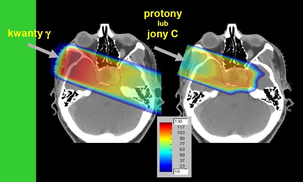 W przypadku wiązki fotonów największe dawki są przed obszarem nowotworu, a i za nim niewiele są mniejsze. Rys.3.B.