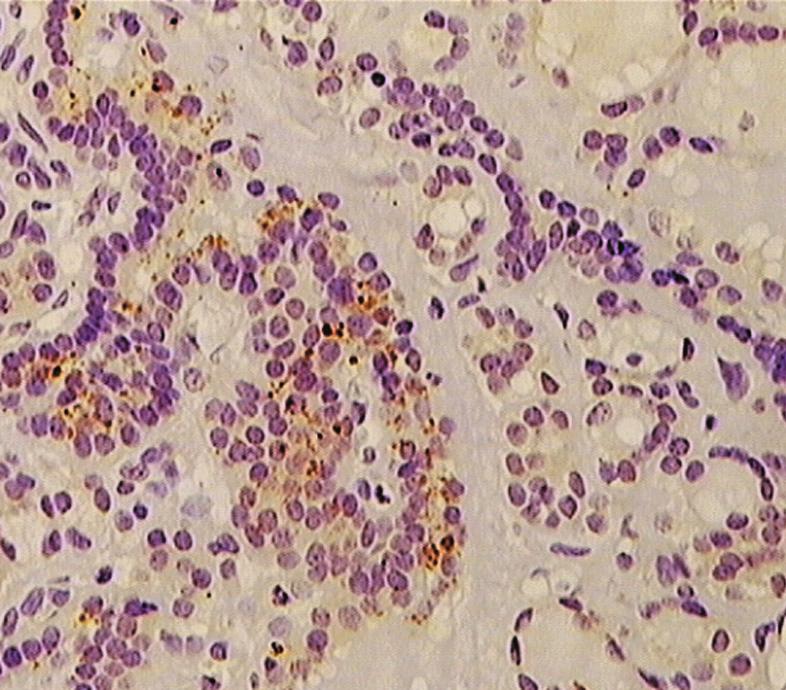 PierwszBeń-Skowronek I. i inni Subpopulacje limfocytów w tkance tarczycowej w autoimmunologicznych i nieautoimmunologicznych chorobach tarczycy tarczycy... Fot.1.