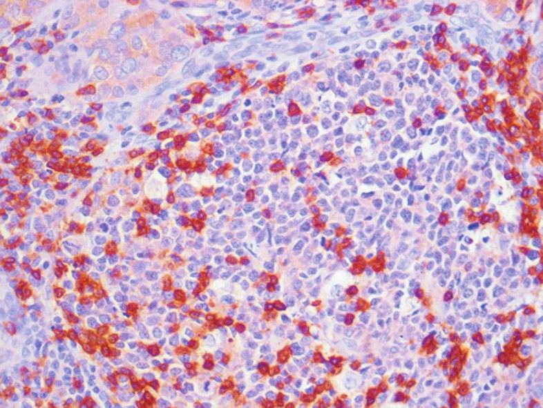 2. Limfocyty T-pomocnicze CD4+ w grudce chłonnej i miąższu tarczycy pacjenta z chorobą GravesaBasedowa. Pow. 20