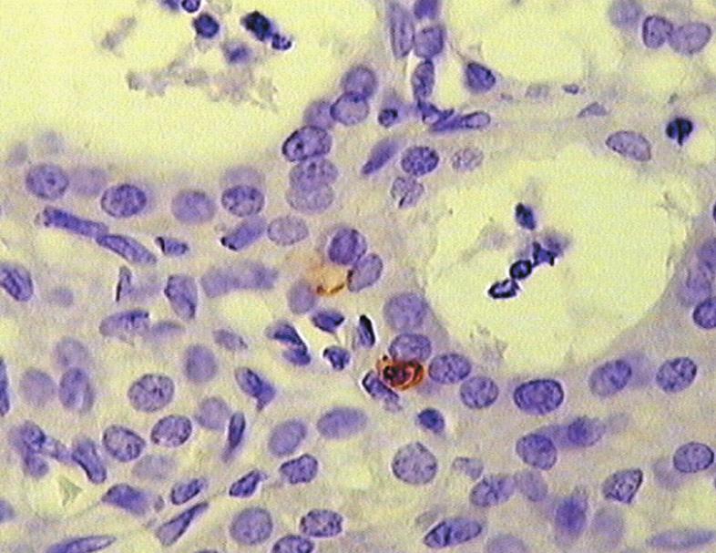 Limfocyty T-supresorowo/cytotoksyczne CD8+ w grudce chłonnej i miąższu tarczycy pacjenta z chorobą Gravesa-Basedowa. Pow. 200x Phot. 3.