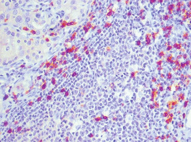 Limfocyty T-supresorowo/cytotoksyczne CD8+ w miąższu tarczycy pacjenta z chorobą GravesaBasedowa. Pow. 400x Phot. 4. The T-suppressor/cytotoxic cells CD8+ in the thyroid tissue in patient with Graves disease.