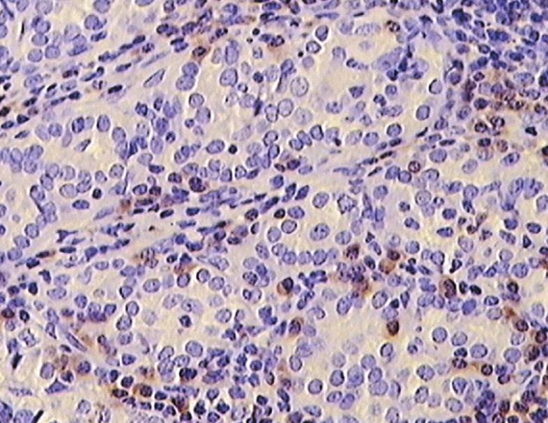PierwszBeń-Skowronek I. i inni Subpopulacje limfocytów w tkance tarczycowej w autoimmunologicznych i nieautoimmunologicznych chorobach tarczycy... Fot. 5.