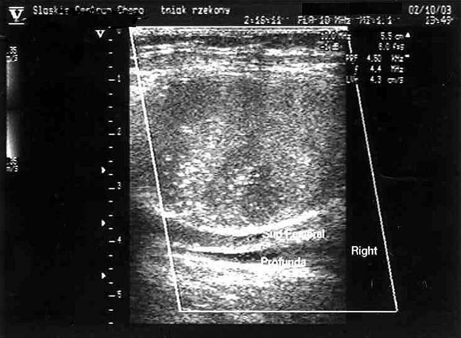 Right femoral pseudoaneurysm in 53 year old female patient before thrombin injection (A), complete thrombosis (B), resolution in 7 days time (C) ronarografię drogą nakłucia prawej tętnicy udowej