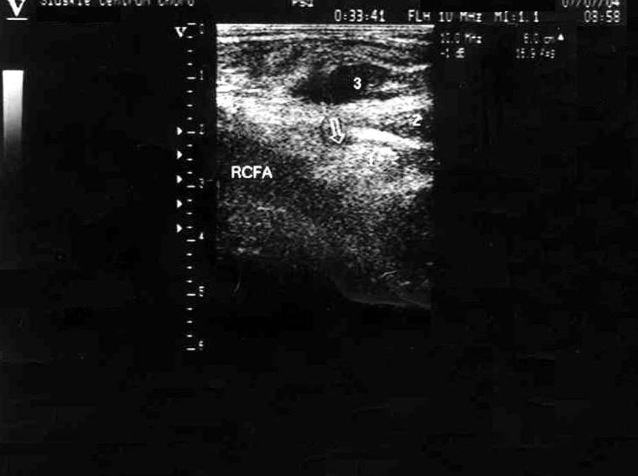 Right femoral pseudoaneurysm in 67 year old male patient before (A) and after (B) thrombin injection. Arrow indicates thrombosed chamber 1 of PSA.