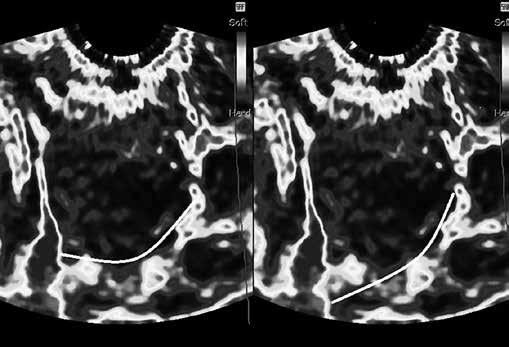 A internal os (red, Elastography Index = 4 points) B external os (red, Elastography Index = 4 points) C cervical canal (from blue to yellow, Elastography Index = 3 points) D anterior wall of the