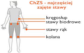 Czym jest choroba zwyrodnieniowa stawów? Choroba zwyrodnieniowa stawów (ChZS) jest najczęstszą przyczyną dolegliwości ze strony układu ruchu.