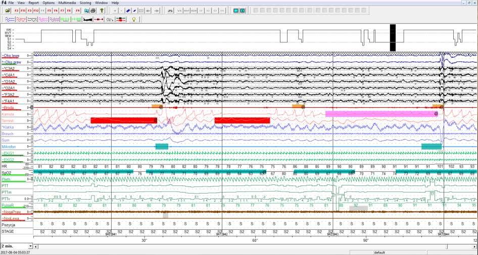 Polisomnografia diagnostyczna AHI=18,7/godz., ODI=28,0/godz.