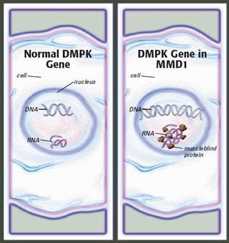 Patogeneza DM poziom RNA Elementy cis Transkrypty z ekspansją powtórzeń zostają w jądrze komórkowym Tworzą struktury drugo-, trzecio- i