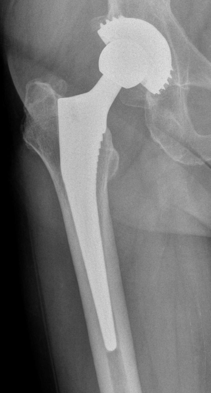 Drobniewski M. et al., Results of Hip Joint Arthroplasty with Corail Stem Ryc. 1.