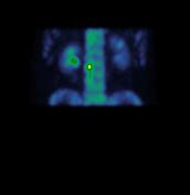 SPECT/CT