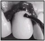 . Do strzykawki z silanem Ultradent Silane używa się końcówek pędzelkowych Black Mini Brush tip. Przed użyciem wytrawiacza do porcelany Ultradent Porcelain Etch* w jamie ustnej należy sprawdzić (np.