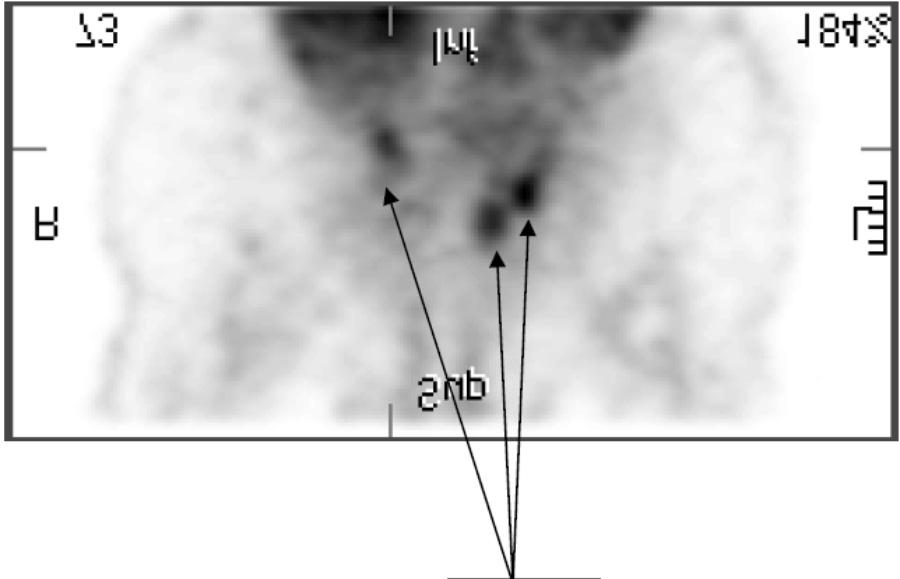 Vain thrombus in lower limbs and in the lung artery zakrzepicą żylną i zatorem tętnicy płucnej, z satysfakcjonującymi wynikami czułości i specyficzności metody.