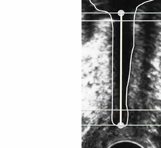 Urethral length measurement in women during sonographic urethrocystography an analysis of repeatability and reproducibility The volume of urine in the bladder was evaluated during transabdominal