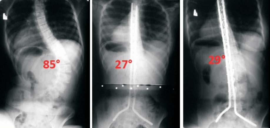 Results of surgical treatment of spine deformities in patients with spinal muscular atrophy type II and type III 61 bracing may diminish the respiratory function in nonambulatory patients and