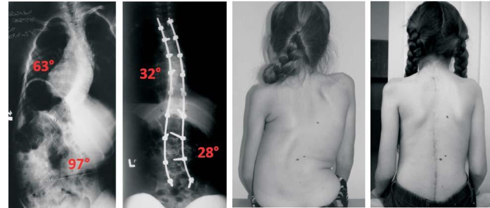 62 T. POTACZEK The surgical technique used by the authors leads not only to curve correction but also to alignment of the pelvis, what leads to better comfort of sitting.