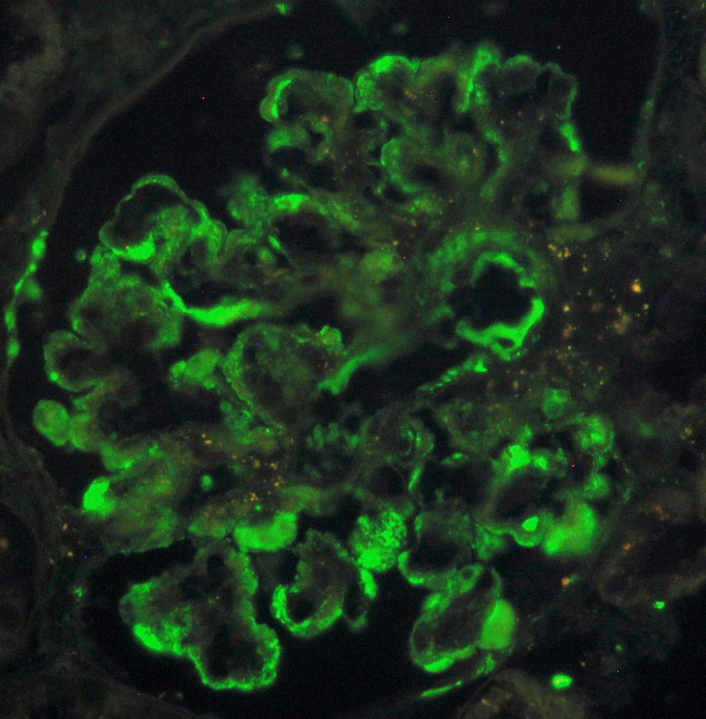 Rycina 10 Glomerulopatia C3. Złogi C3 wydłuż okonturowania części kapilar kłębuszkowych. Badanie immunomorfologiczne. C3 glomerulopathy. C3 deposition along some of the capillary walls.