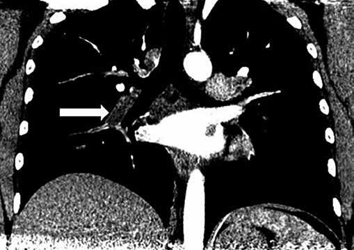 Pulmonary CT angiography the defect in contrast fillings in the intermediate artery on the