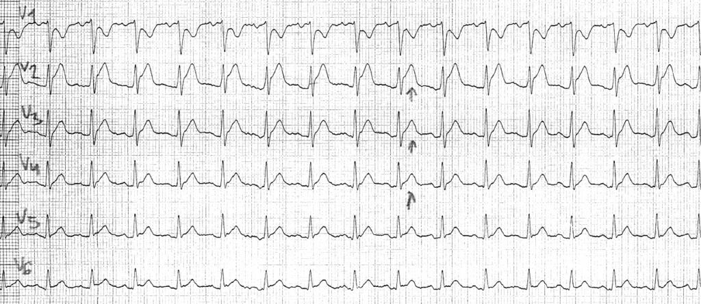 Swoisty ból towarzyszący AP był obecny u wszystkich chorych z AP ocenianych w badaniach ICAP (Investigation on Colchicine for Acute Pericarditis), CORP (Colchicine for recurrent pericarditis) i COPE