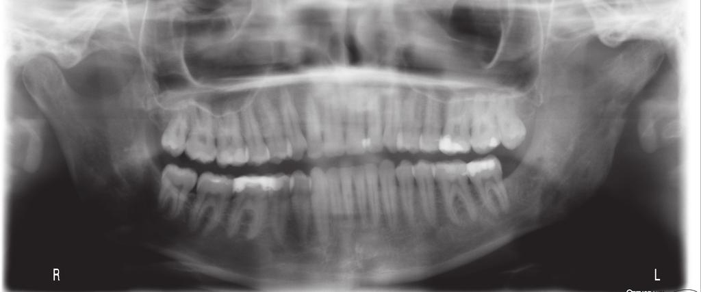 J Stoma 2016; 69, 2 Szkutnik J., Litko M., Różyło-Kalinowska I., Piskórz M. Fig. 1. Panoramic radiograph (December 2014). Osteolytic foci in the left ramus of the mandible.