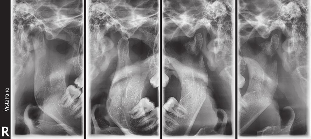 Zdjęcie ssż (marzec 2015 roku). Patologiczne złamanie lewego wyrostka kłykciowego żuchwy. that a TMJ x-ray in maximum intercuspation and disclusion be taken.