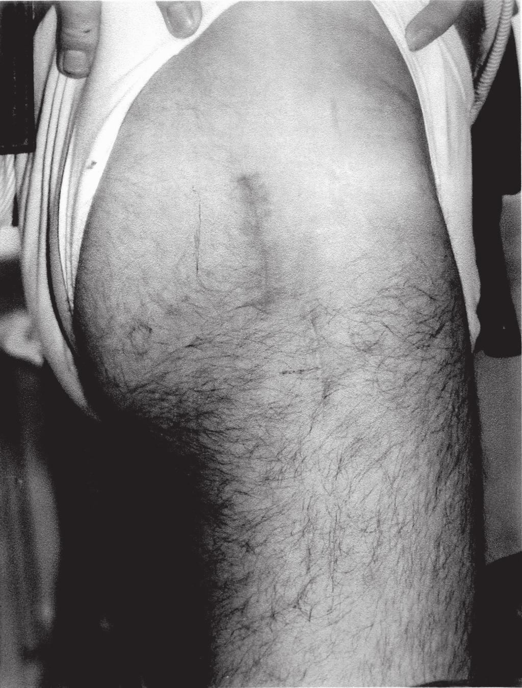 R¹pa³a K. et al., Minimally invasive total hip arthroplasty Ryc. 1c.
