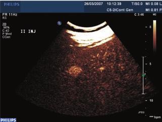 Ultrasonograficzny środek kontrastujący III generacji SonoVue w diagnostyce naczyniaków wątroby o nietypowych cechach w badaniu... Ryc. 2 e.