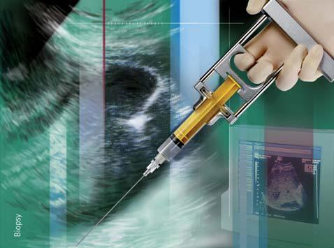 Biopsja Sonocan zestaw do biopsji cienkoig owej pod kontrolà USG Zestaw Sonocan wraz z uchwytem aspiracyjnym kombinacja mi dzy jednorazowym a wielorazowym sprz tem do biopsji.