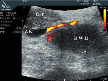 Ultrasonografia śródoperacyjna trzustki 233 Ryc. 2. Badanie IOUS, Doppler mocy GT głowa trzustki, ŻK żyła krezkowa górna, RWH rak wyrostka haczykowatego trzustki (hipoechogeniczny) Fig. 2. IOUS, power Doppler GT pancreatic head, ŻK mesenteric superior vein, RWH cancer of uncinate process (hypoechoic) [3, 6, 9].