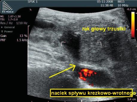Umożliwia to przecięcie więzadła żołądkowo-okrężniczego oraz mobilizacja dwunastnicy (manewr Kochera) [7].