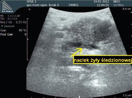 234 Grzegorz Ćwik, Michał Solecki, Andrzej Dąbrowski, Grzegorz Wallner Ryc. 4. Badanie IOUS. Rak trzonu trzustki, nacieczenie żyły śledzionowej Fig. 4. IOUS. Pancreatic body cancer, infiltration of the splenic vein Ryc.