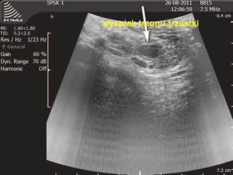 Ultrasonografia śródoperacyjna trzustki 235 Ryc. 7. Badanie IOUS. Hipoechogeniczny, dobrze odgraniczony guz trzonu trzustki, 12 mm. Wyspiak trzustki otoczony niezmienioną tkanką Fig. 7. IOUS. Hypoechoic, well-demarcated tu - mor body of the pancreas, 12 mm.