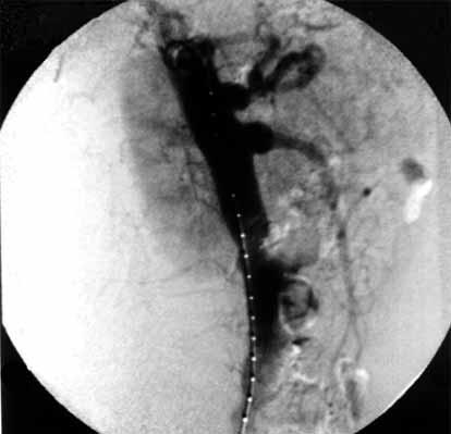 Acta Angiol., 2008, Vol. 14, No. 3 Figure 1. Lateral arteriogram showing aneurysms of the initial sections of the coeliac trunk and the upper mesenteric artery Rycina 1.