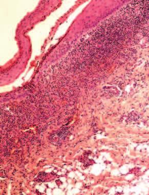 Obraz histopatologiczny i immunohistochemiczny w liszaju płaskim 377 Tabela 2. Liczebności limfocytów CD3+, CD4+, CD8+ oraz komórek CD57+ w liszaju płaskim in situ Table 2.