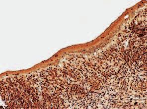 378 I. KOZAK et al. Ryc. 4. Liszaj płaski. Barwienie immunohisto chemiczne z CD4. Powiększenie obiektywu 10. Liczne limfocyty T CD4+ w obfitym nacieku zapal nym pod nabłonkiem Fig. 4. Lichen planus, immunohistochemical staining (CD4), objective lens magnification 10.