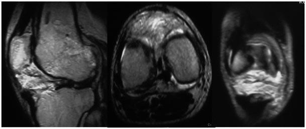 Jabłoński J. et al., Reconstruction of Chronic Patellar Tendon Rupture Ryc.1. Przedoperacyjne rentgenogramy pokazujące wysokie ustawienie rzepki Fig. 1.