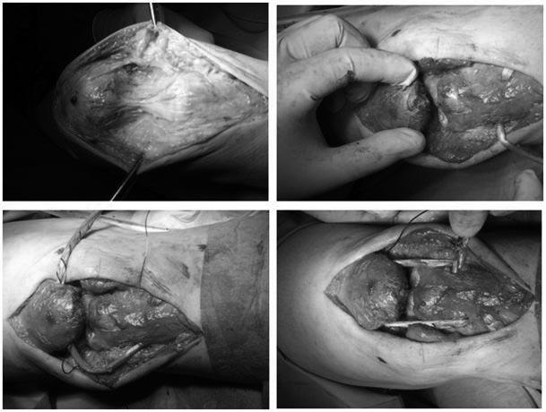 Jabłoński J. et al., Reconstruction of Chronic Patellar Tendon Rupture Ryc. 3. Kolejne etapy rekonstrukcji więzadła rzepki przeszczepem ze ścięgna m.