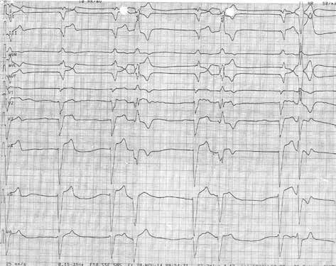 Folia Cardiologica 2015, tom 10, supl. C Rycina 1. serca.