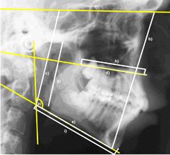 J. Kostrzewa-Janicka Cel pracy Celem pracy była analiza zależności wartości siły zgryzowej od budowy anatomicznej części twarzowej czaszki u pacjentów ze schorzeniami skroniowo-żuchwowymi.