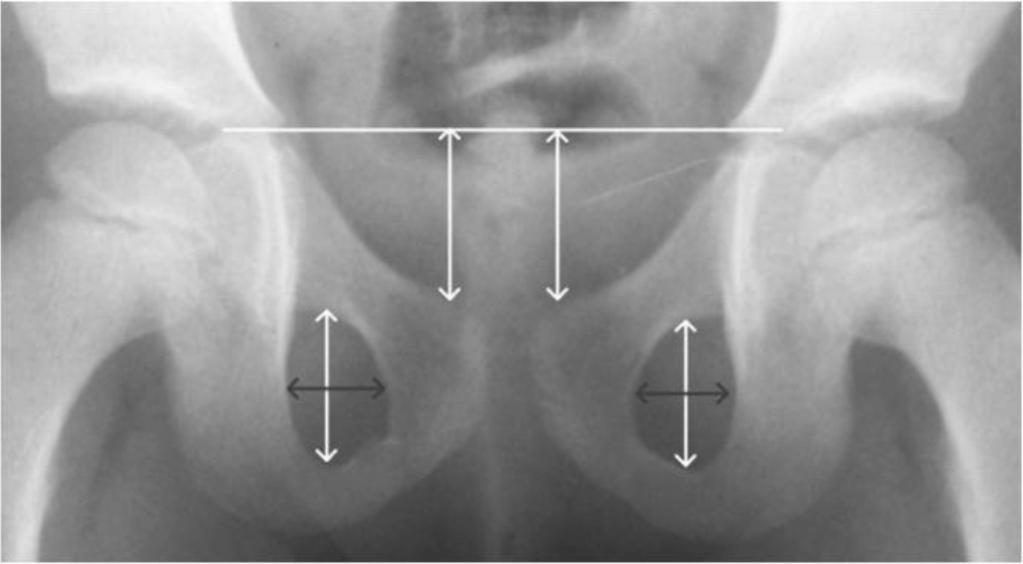 12 E. Adamczyk i wsp. Ryc. 1. Sposób pomiaru wskaźników ustawienia miednicy: rotacji i pochylenia. Fig. 1. Methods of measuring of pelvis: a rotation and tilt. Ryc. 3.