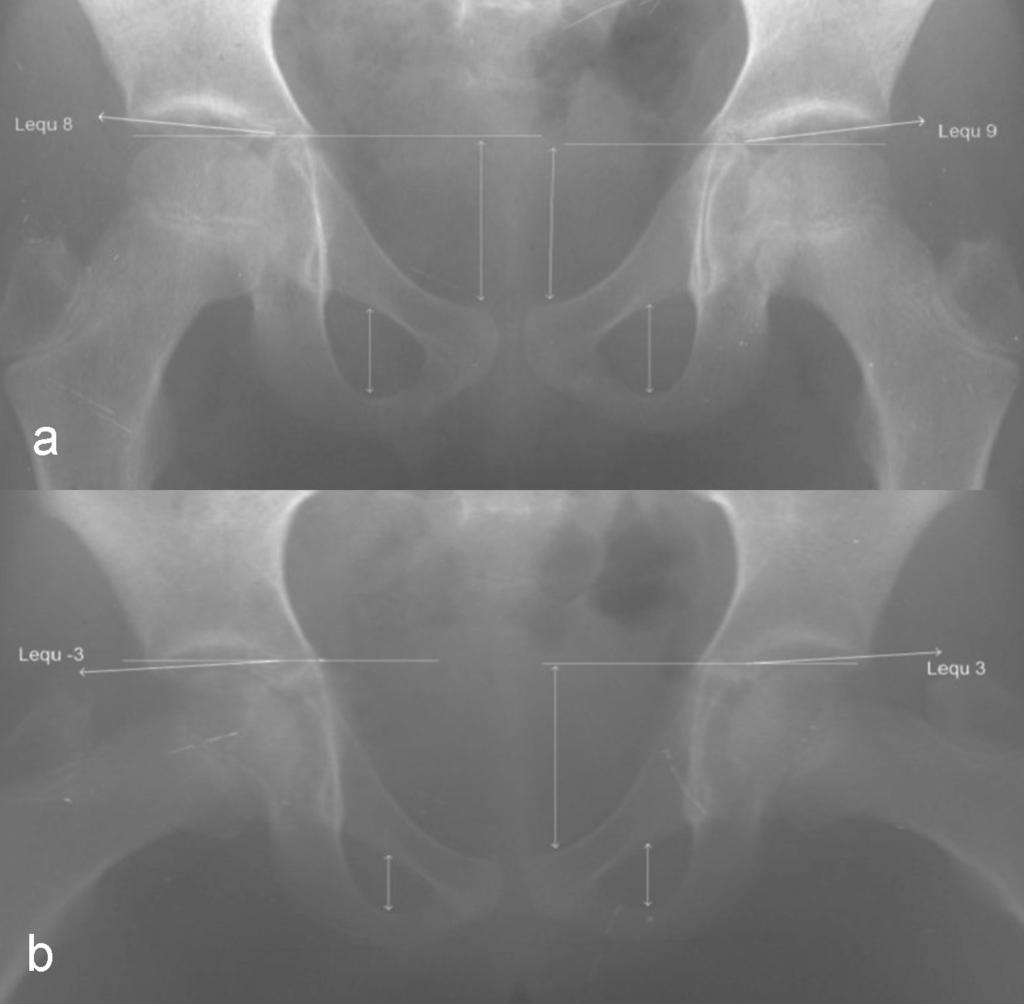 Differences in the measurement of the angle of Ullmann- Sharp on two radiographs ofthe same patient with a high of obturator foramen: a) in the anteroposterior projection, b) in the Lauenstein