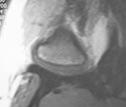 MR ssż po leczeniu repozycyjną szyną zgryzową w maksymalnym zaguzkowaniu zębów: w płaszczyźnie strzałkowej obustronna repozycja krążków stawowych, w płaszczyźnie czołowej obustronna częściowa