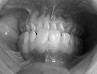 M. Litko i inni Ryc. 7. Maksymalne zaguzkowanie zębów po leczeniu repozycyjną szyną zgryzową i odbudowie powierzchni zwarciowych.