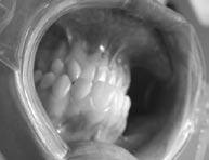 ekstrakcji zębów w bocznych strefach podparcia, w wyniku czego, pomimo młodego wieku pacjentki doszło do przekroczenia zdolności adaptacyjnych układu ruchowego narządu żucia.