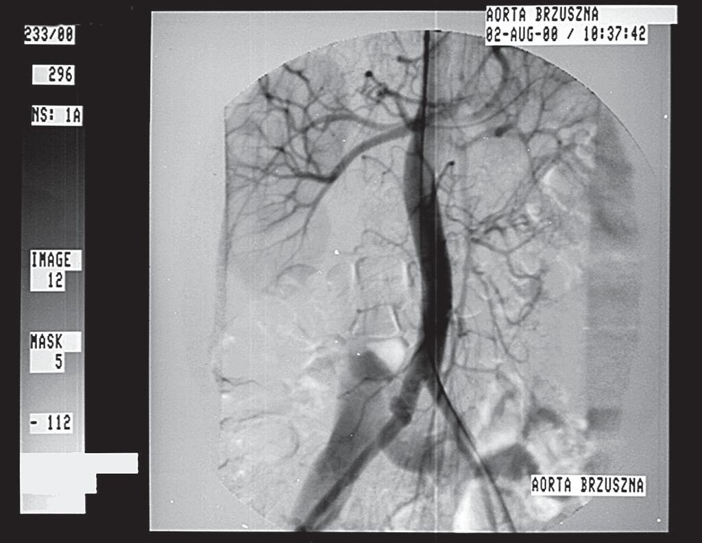 Iatrogenic fistula of iliac vessels, Kowalik et al. Figure I. Arteriovenous fistula of iliac vessels in arteriography Rycina 1.