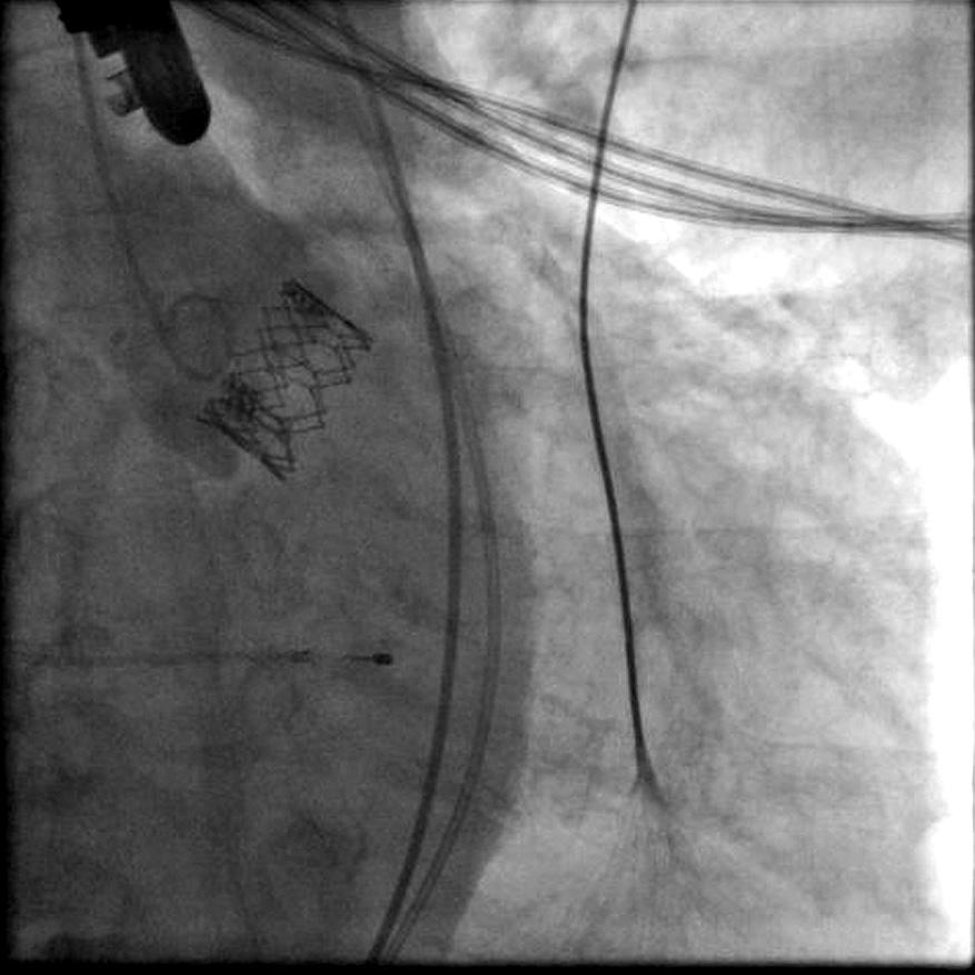 Annulus calcifications are a marker of correct valve positioning. An early phase of the Sapien XT valve expansion with a balloon is show Ryc. 6. Zastawka Sapien XT bezpośrednio po implantacji.