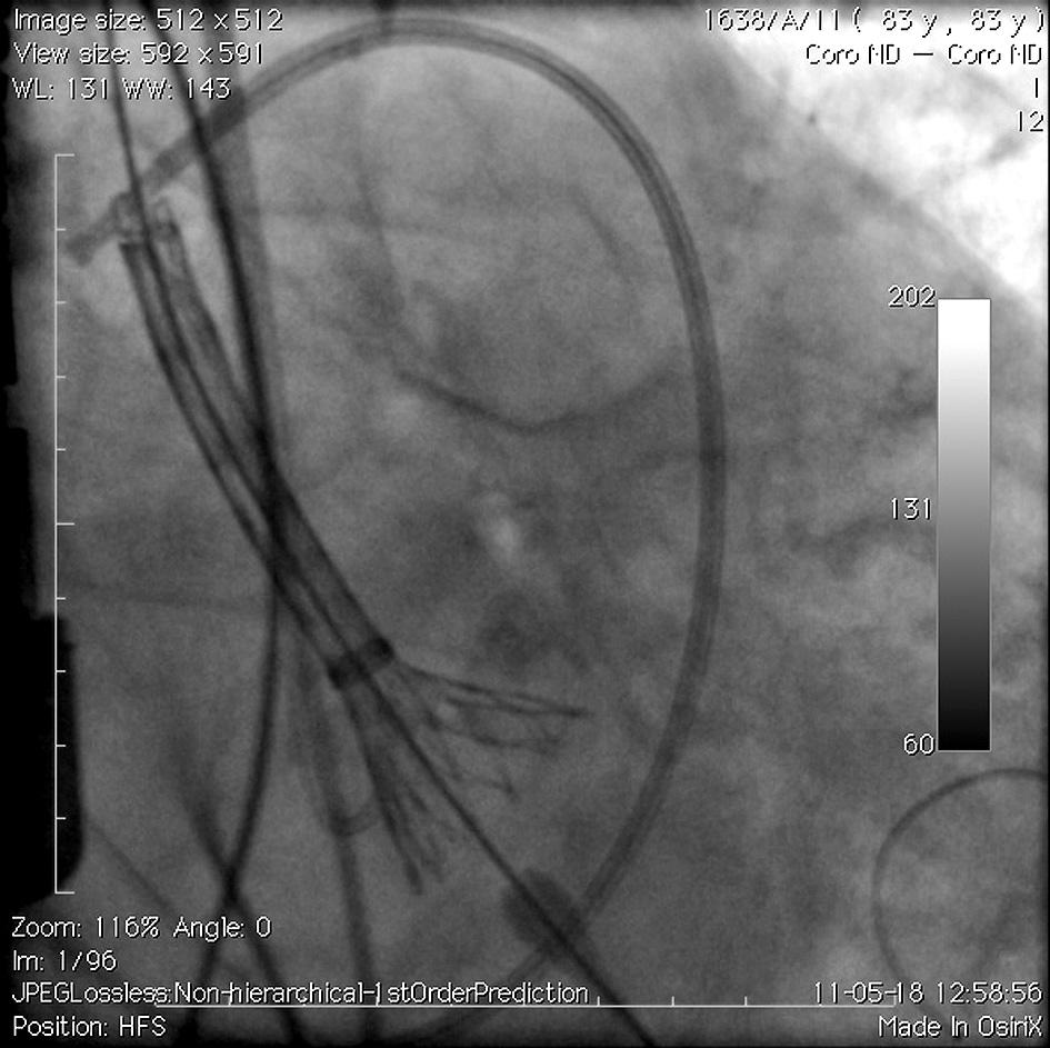 Ryc. 7. Początek implantacji zastawki CoreValve 26 mm. Dystalna część nitinolowego stentu została uwolniona kilka milimetrów pod pierścieniem aortalnym.