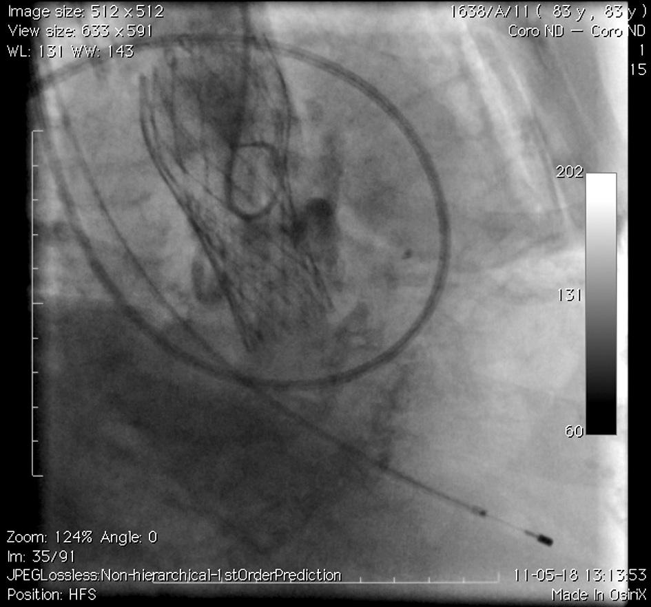 A distal part of the nitinol stent was released a few millimetres below the aortic annulus.